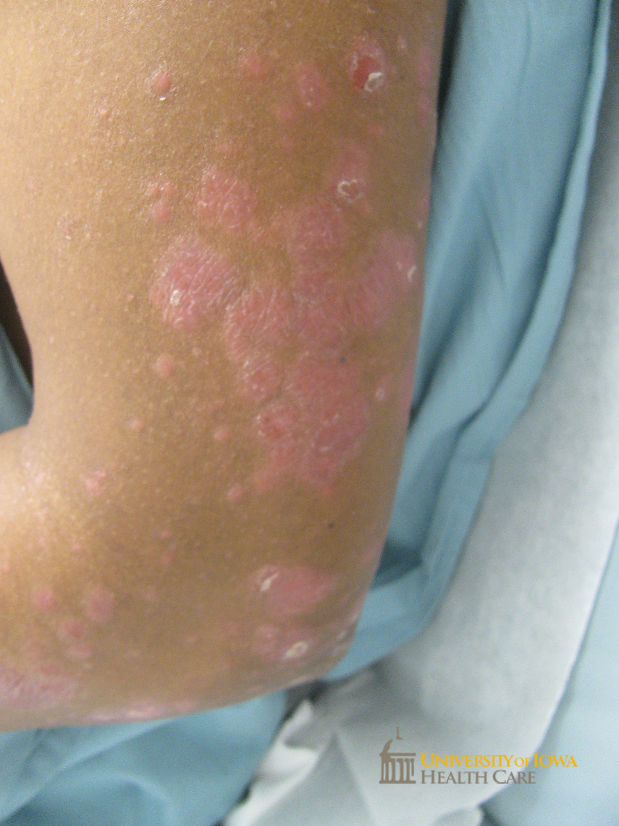 Salmon-colored scaly papules and plaques on the arm. (click images for higher resolution).
